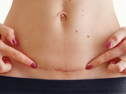 When does the c section image.